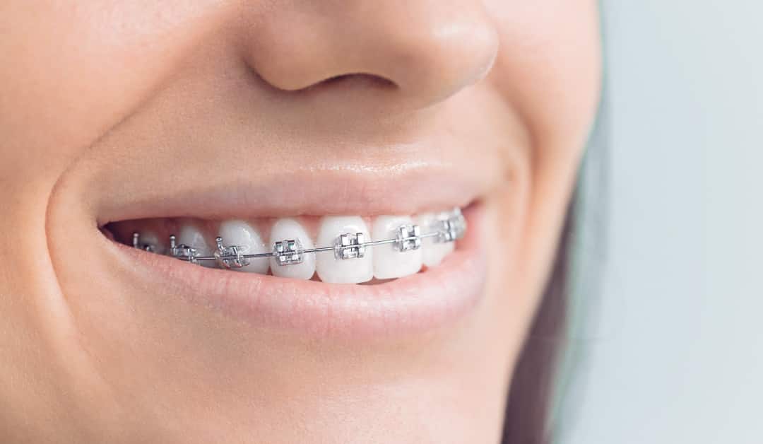 Braces Idea Dental Johor Bahru