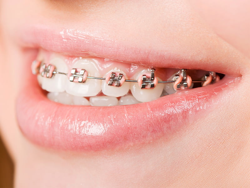 Braces Idea Dental Johor Bahru